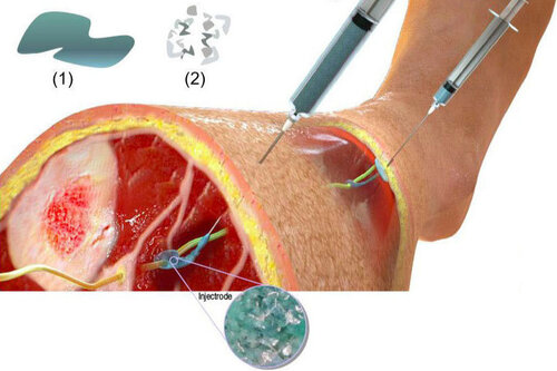 A demonstration of the injectrode going into the body